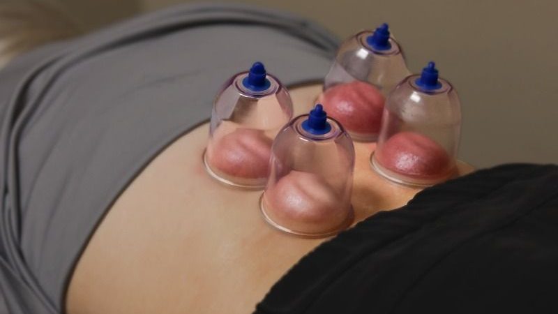 Cupping therapy session at ProActive Chiropractic and Wellness